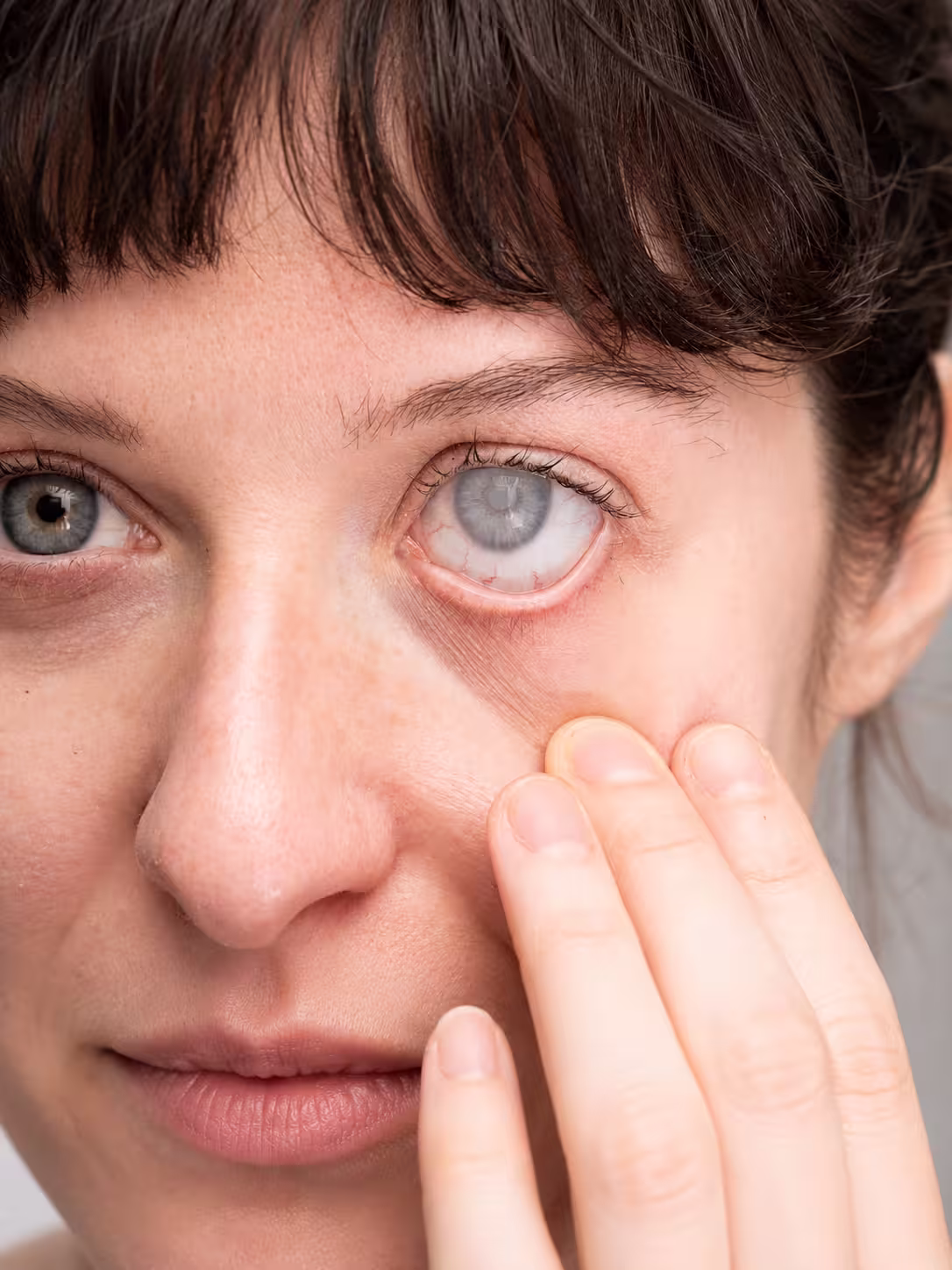 glaucoma